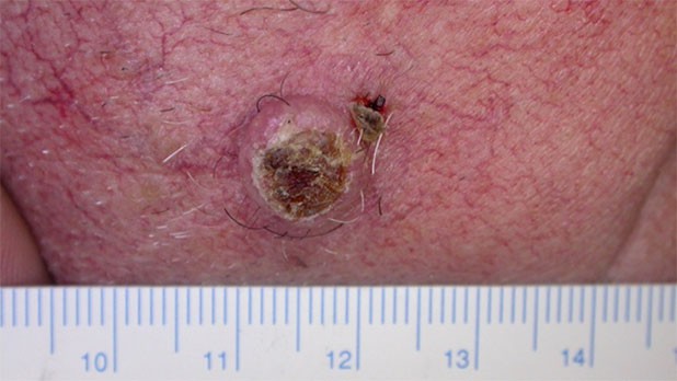 The prevention and early detection of skin cancer in